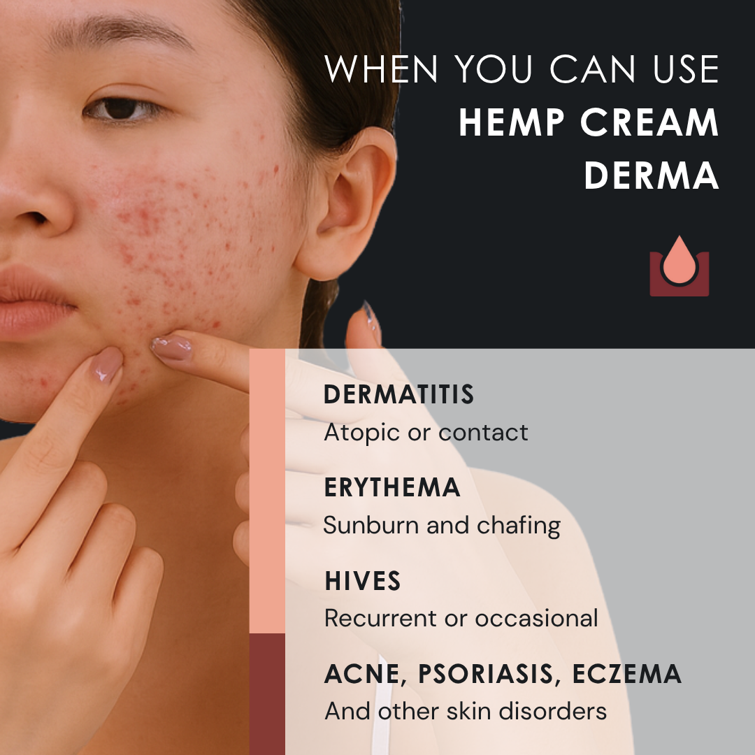 4DERMA - Natural Soothing Face and Body Cream for Eczema, Acne and Psoriasis - 50 ml