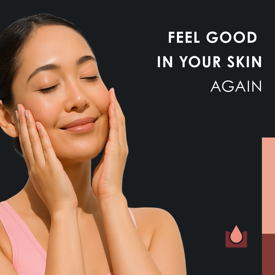 4DERMA - Natural Soothing Face and Body Cream for Eczema, Acne and Psoriasis - 50 ml