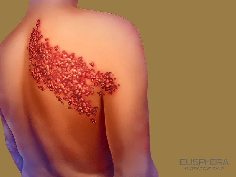 Shingles: What It Is and How to Relieve Symptoms with CBD and Other Natural Remedies