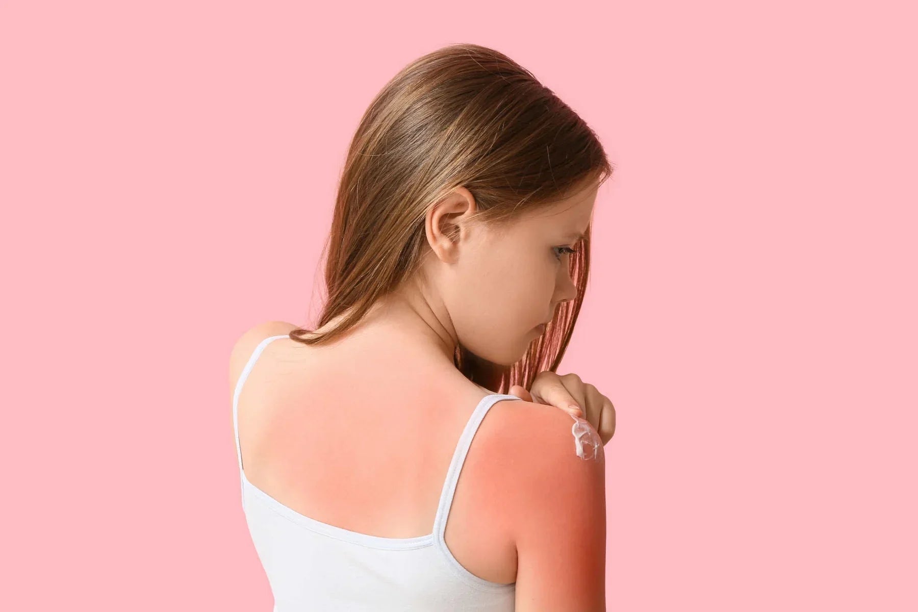 Natural remedies for sunburn and practical tips to prevent it